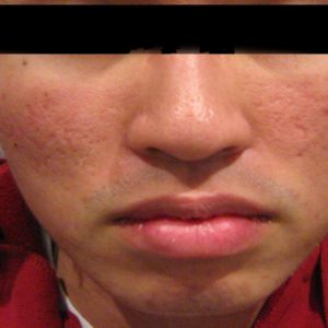 Acne_Scarring_Before_Fraxel_Laser_Treatment