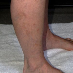 After_Leg_Vein_Sclerotherapy_Treatment
