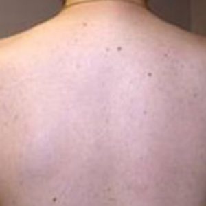 Back_Hair_After_IPL_Hair_Removal