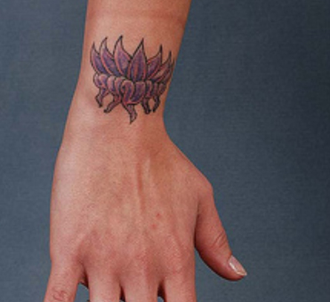 Laser Tattoo Removal: Risks, Side Effects and Costs