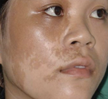 Revlite Laser Skin Resus