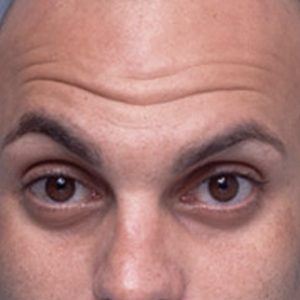 Men-forehead lines-before-wrinkle-relaxer