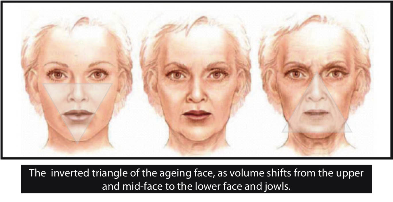 Группы возрастных изменений. Гравитационный птоз лица. Гравитационный птоз нижней трети лица. Гравитационный птоз мягких тканей лица.