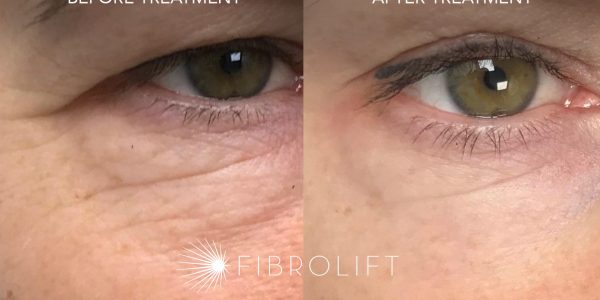 Before and after Fibrolift eye treatment