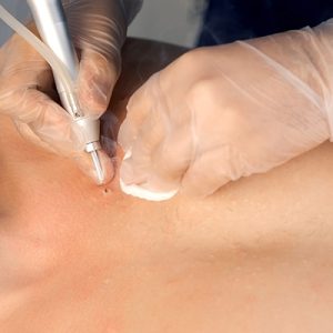 Surgeon removing moles and acne on man's chest using laser in hospital, hands in gloves closeup. Remove nevus on chest. One day surgery concept. Sore and wound after operation.